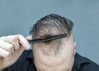 Greffe de cheveux à Paris